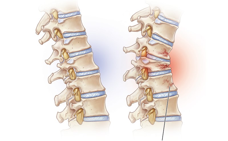 Здоровый позвоночник против позвоночника с низкой плотностью костной ткани и компрессионными переломами.