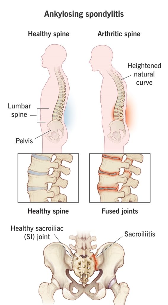 Анкилозирующий спондилит обычно поражает крестцово-подвздошные суставы (место соединения основания позвоночника с тазом).