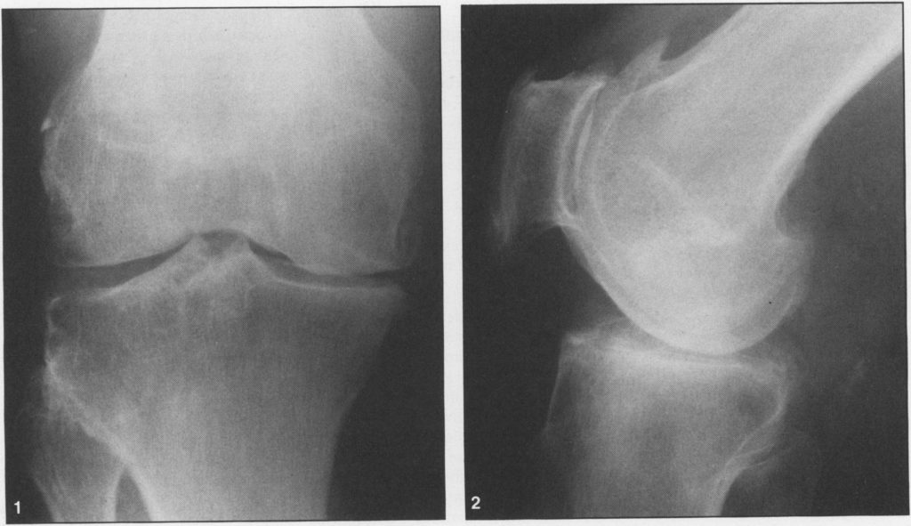 Вид коленного сустава спереди (рис. 1) и сбоку (рис. 2), показывающий типичные изменения при остеоартрозе в медиальном и пателлофеморальном отделах.