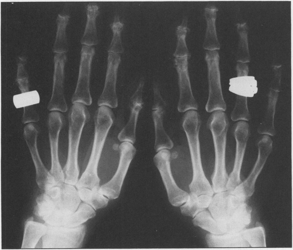 Рентгенограмма кистей рук, на которой видны типичные изменения при остеоартрозе во многих суставах.