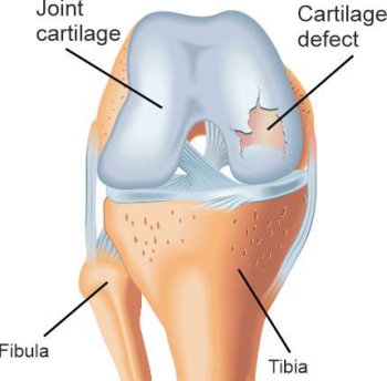 Схематическая иллюстрация дефектов хряща колена