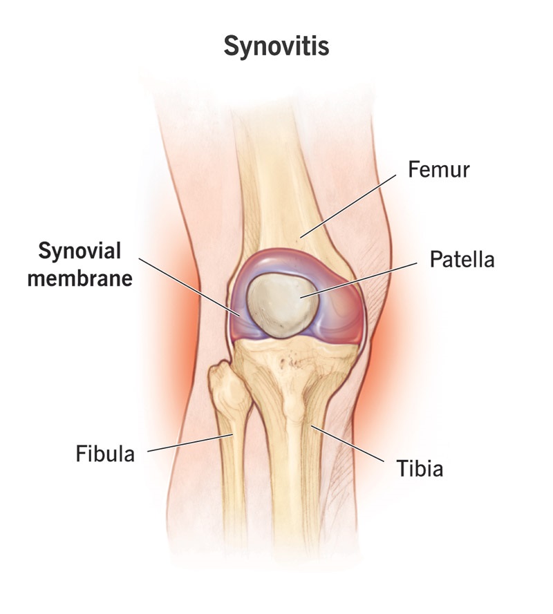 Иллюстрация коленного сустава, пораженного синовитом.